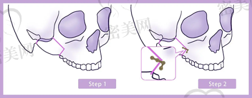 李正鹏医生怎么预约挂号？