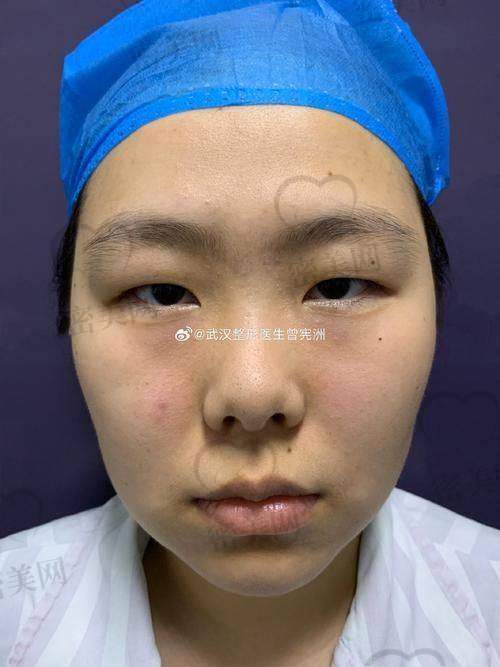客户实录：她们是怎么评价张冰洁眼修复术的？
