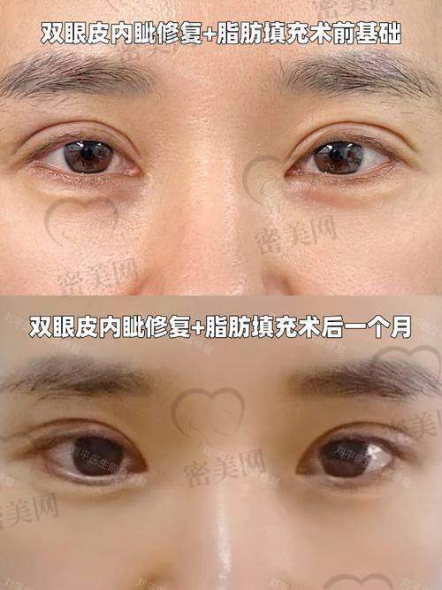 佀同帅双眼皮修复怎么样？大众点评口碑好