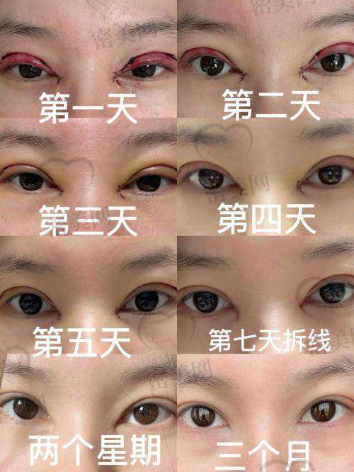 术前术后对比实例：不是简单“放大”，是动态改善
