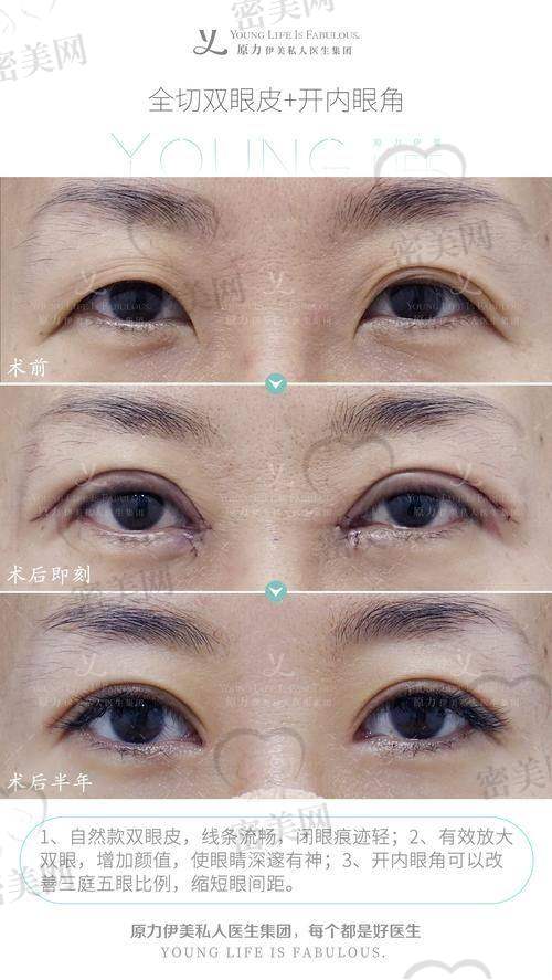 结尾：开外眼角值不值得做？核心答案在于设计与技术
