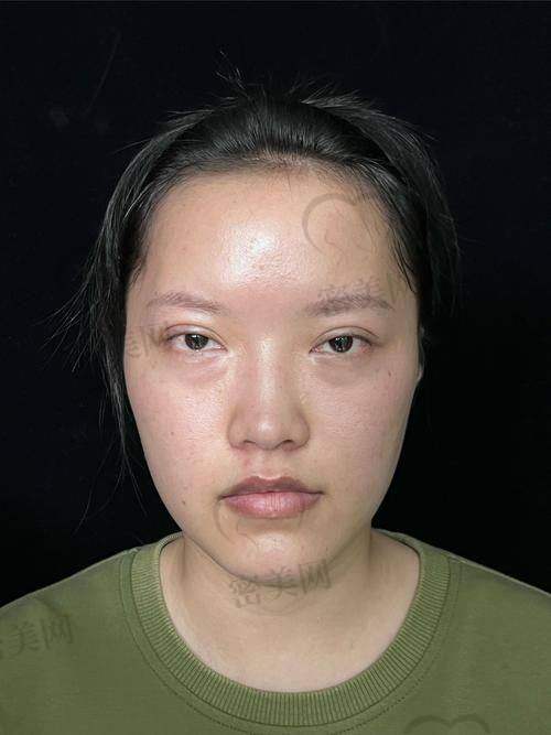 张冰洁埋线双眼皮修复多少钱？项目价格详细表来了