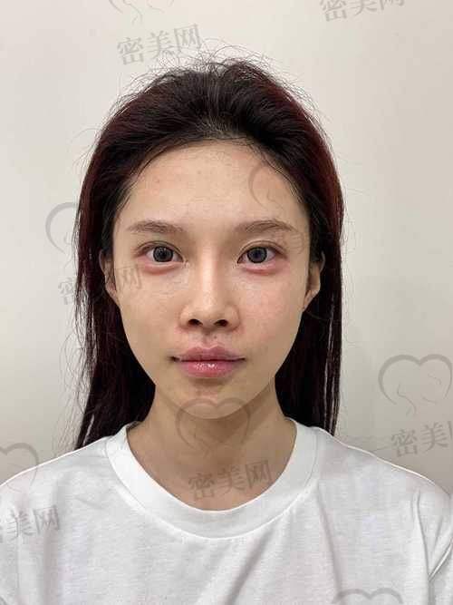卧蚕填充价格大揭秘