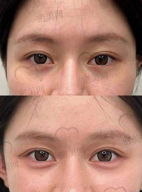 卧蚕填充风险要留意