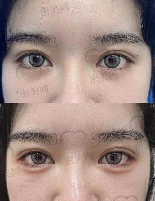 对比其他类型卧蚕术：玻尿酸 or 真皮？你是哪种适配体质