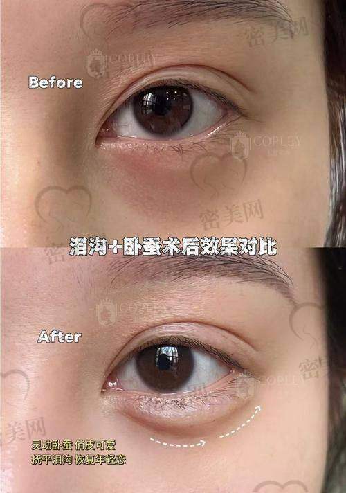 卧蚕填充修复期那些事儿