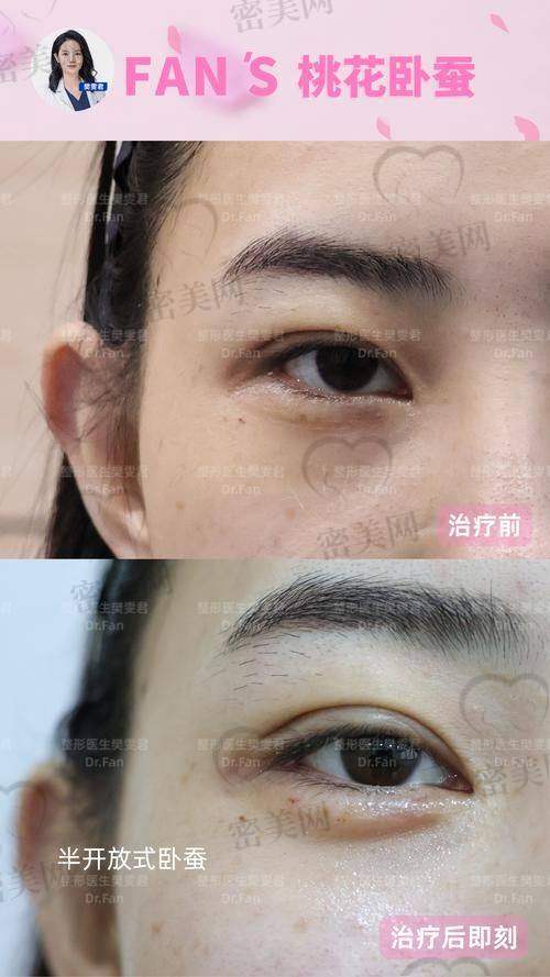为什么张冰洁的真皮卧蚕备受追捧？这几点太关键