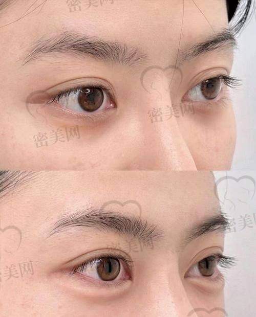 玻尿酸卧蚕填充成效咋样