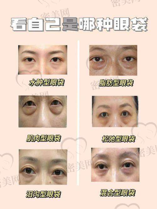眼袋修复不仅是“补伤口”，更是还你一双灵动的眼
