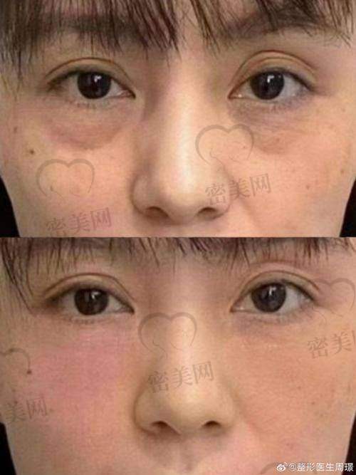 结语：与其每年反复祛眼袋，不如一次找对医生