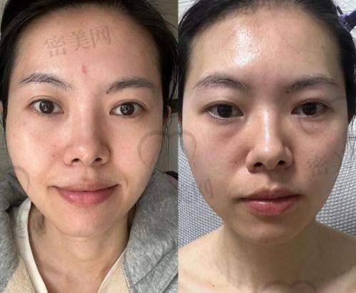 张冰洁为啥能修复“千疮百孔”的失败眼袋？