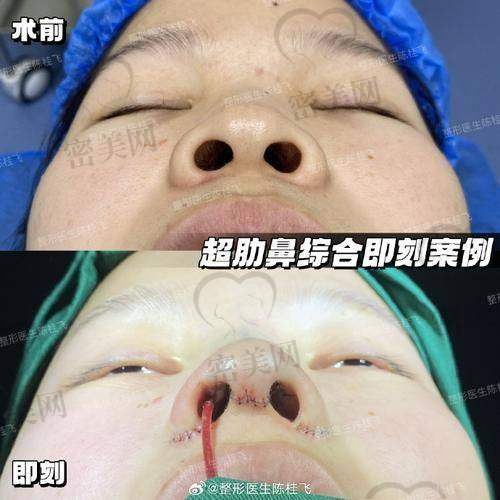 上海华美李健和谢卫国哪个好，实例对比见分晓！