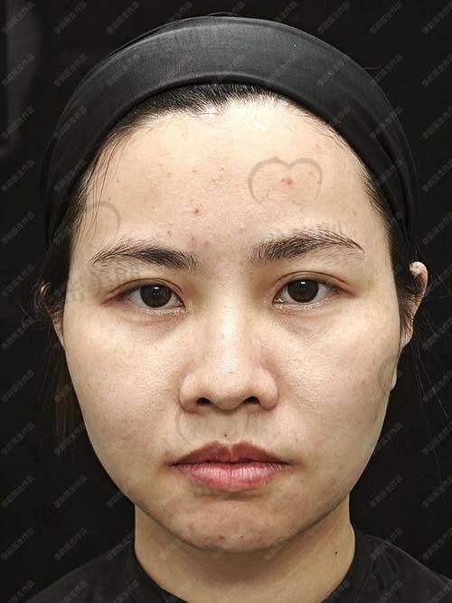 法令纹填充童颜针有啥注意事项？
