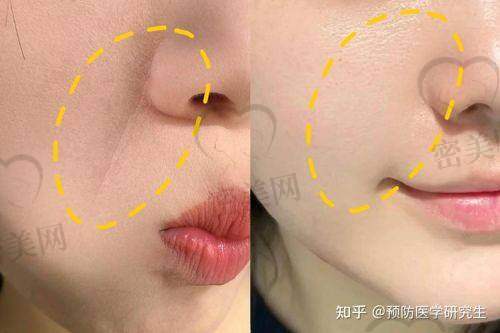 填充15天越看越别扭咋回事？