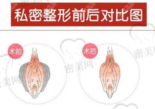 私密整形术后维养/复诊节点要记牢