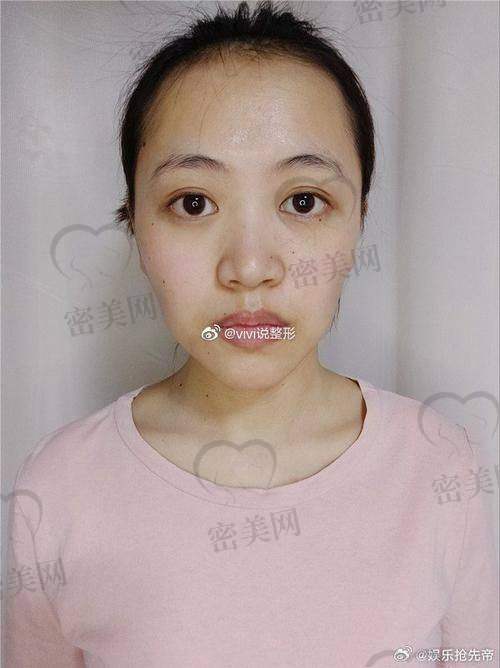 填充成效哪家强