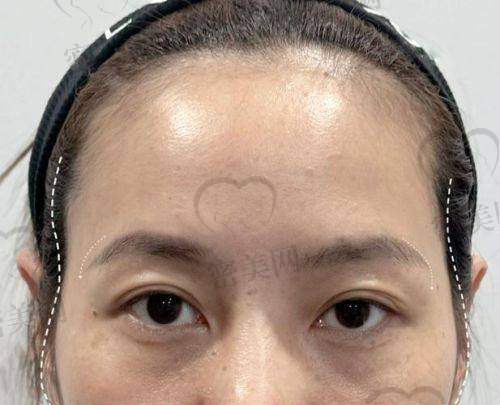 不同部位玻尿酸填充价格大揭秘