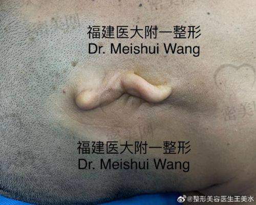 济南铂莱美医疗整形医院：进口支架助力成人耳重建