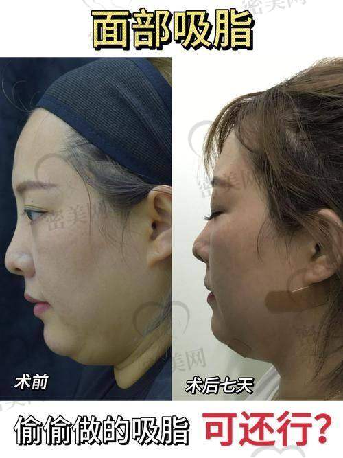 神奇的不带头套面部吸脂手术过程