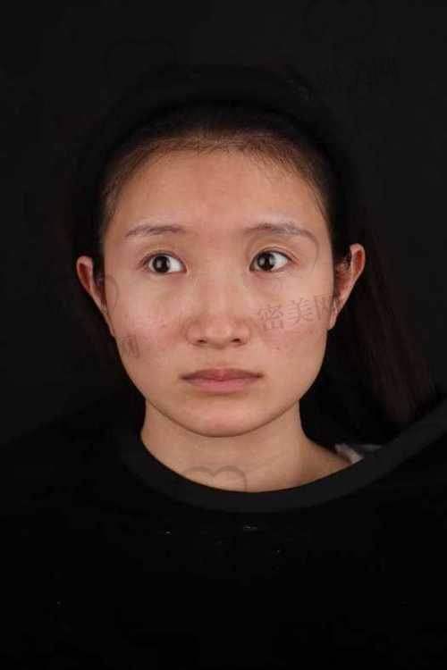 上海华美李志海颧骨内推技术大揭秘