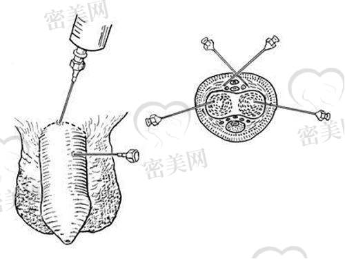 上海伯思立整形程开祥手术：真人实例见证奇迹