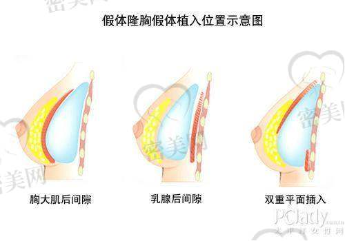 上海伯思立周珍艳假体隆胸的技术优势大揭秘