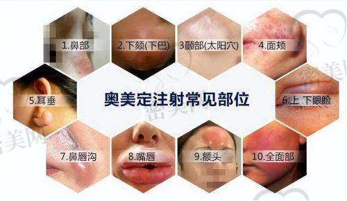 上海伯思立周珍艳假体隆胸的真人实例秀