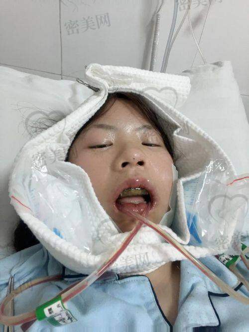 术后修复建议及常见疑问答复