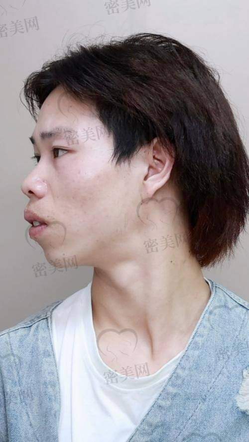 广州广大医院正颌手术流程全方面解读