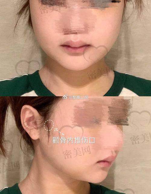 上海华美李志海颧骨内推专精能力咋样？