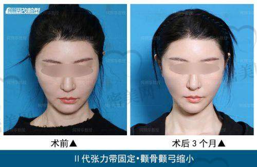 李运峰医生值得选吗？从术后满意度、技术操作、手术风格多角度回答你
