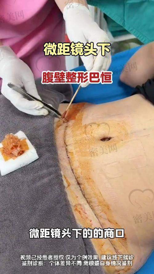 上海伯思立整形倪锋腹壁成形：口碑爆棚的秘密