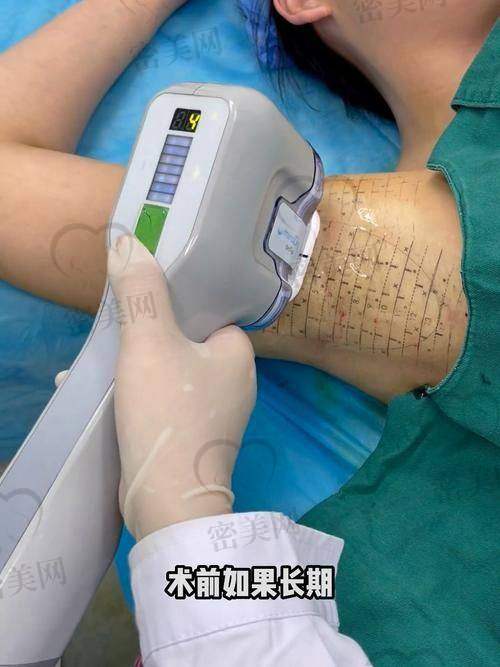 上海伯思立整形顾建成微波腋臭：口碑评价超棒