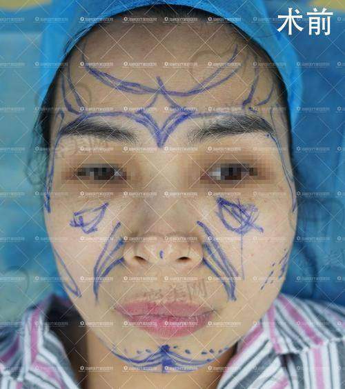 张朋医生面部脂填充技术优势大揭秘