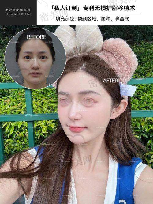 张朋医生面部脂填充成功实例大赏