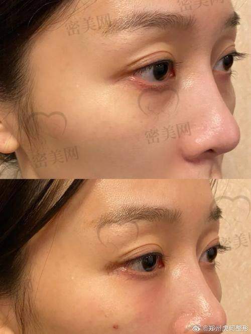 总结一下，做泪沟填充那些事儿