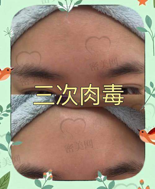 去除抬头纹的常见医美项目