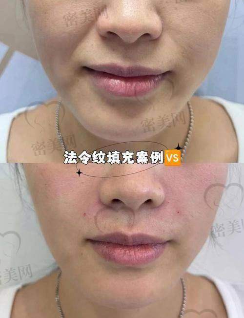 手术去法令纹