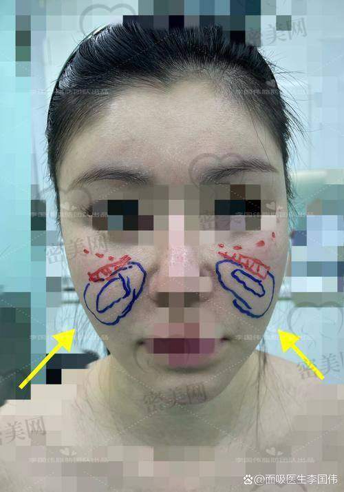 肉毒素注射去法令纹