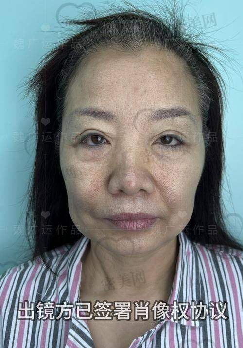 去法令纹手术的风险与注意事项