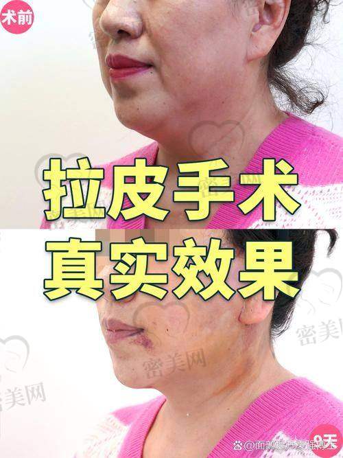 不同手术的优缺点及适合人群