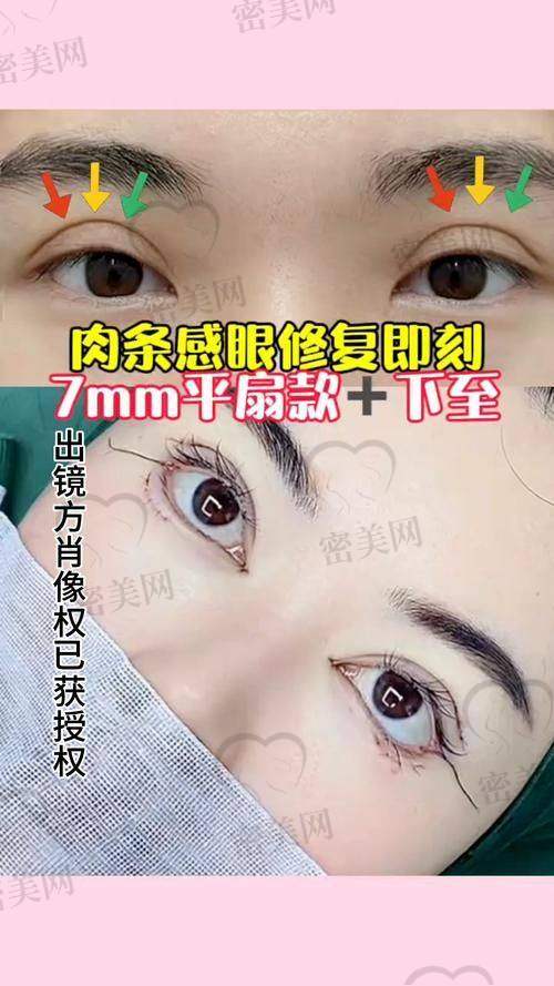 如何预约张冰洁医生进行外眼角修复？