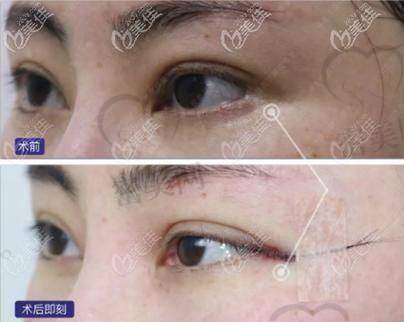 外眼角修复：这些人更应该重视术后追修