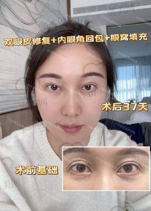 张冰洁外眼角修复为什么值得信赖？5大口碑关键词证明实力