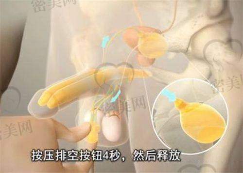 徐和林医生技术特点：