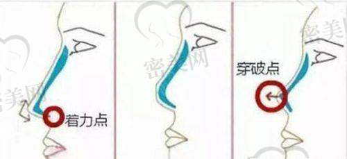 章圣医生技术特点：