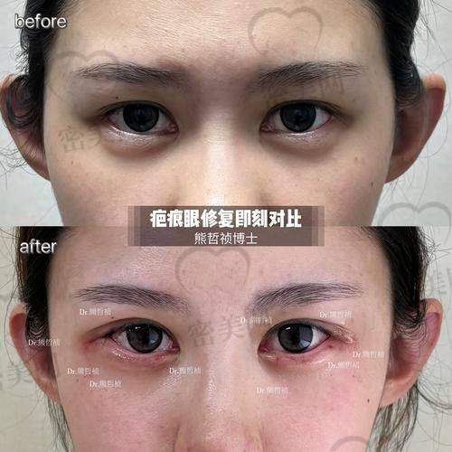 陈小剑修复双眼皮实例分享：技术优势特别哇塞