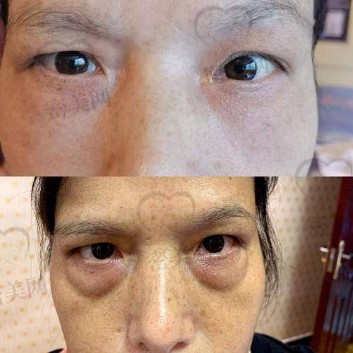 北京嘉和丽医疗美容医院——内切联合外切，更适用于重度眼袋