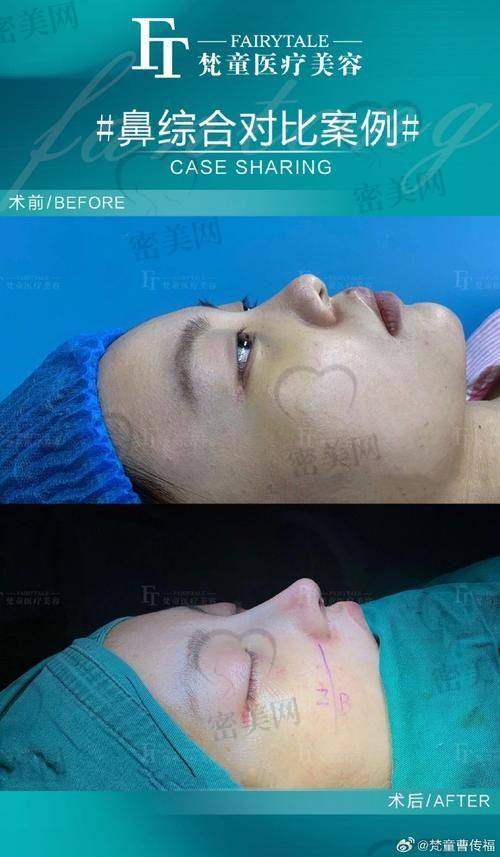 上海伯思立沈国雄：50000 起的鼻修复，价格香迷糊了！