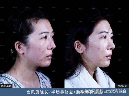 上海伯思立谈宇腾鼻修复：口碑评价超亮眼